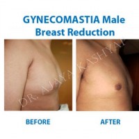 Reviewed by Gynecomastia Surgery