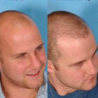 Reviewed by Best Hair Transplant Revive Hair Restoration