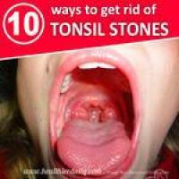 remove tonsil stones