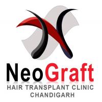 Chandigarh Hair Transplant